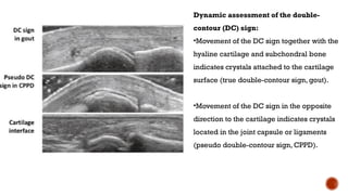 Role of USG in Wrist Joint Pathology and Interventions | PPTX