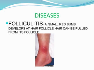 DISEASES
FOLLICULITIS-A SMALL RED BUMB
DEVELOPS AT HAIR FOLLICLE,HAIR CAN BE PULLED
FROM ITS FOLLICLE
 
