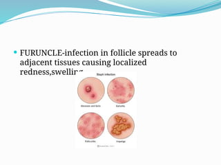  FURUNCLE-infection in follicle spreads to
adjacent tissues causing localized
redness,swelling
 