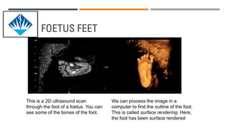 WHAT ARE THE LIMITATIONS OF GENERAL
ULTRASOUND IMAGING?
 Ultrasound waves are disrupted by air or gas; therefore ultrasou...