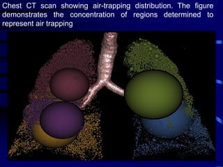 Chest CT scan showing air-trapping distribution. The figure
demonstrates the concentration of regions determined to
represent air trapping
 