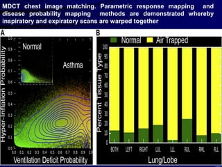 MDCT chest image matching. Parametric response mapping and
disease probability mapping methods are demonstrated whereby
inspiratory and expiratory scans are warped together
 