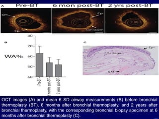 OCT images (A) and mean 6 SD airway measurements (B) before bronchial
thermoplasty (BT), 6 months after bronchial thermoplasty, and 2 years after
bronchial thermoplasty, with the corresponding bronchial biopsy specimen at 6
months after bronchial thermoplasty (C).
 
