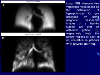 Lung MRI demonstrates
ventilation maps based on
the distribution of
hyperpolarized Xe gas
assessed by using
magnetic resonance
images of a healthy
subject (A) and an
asthmatic patient (B),
respectively. Note the
patchy regions of poor to
no ventilation in patients
with severe asthma.
 