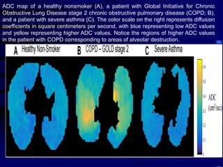 ADC map of a healthy nonsmoker (A), a patient with Global Initiative for Chronic
Obstructive Lung Disease stage 2 chronic obstructive pulmonary disease (COPD; B),
and a patient with severe asthma (C). The color scale on the right represents diffusion
coefficients in square centimeters per second, with blue representing low ADC values
and yellow representing higher ADC values. Notice the regions of higher ADC values
in the patient with COPD corresponding to areas of alveolar destruction.
 