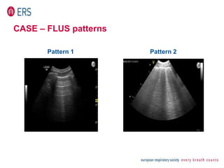 CASE – FLUS patterns
Pattern 1 Pattern 2
 