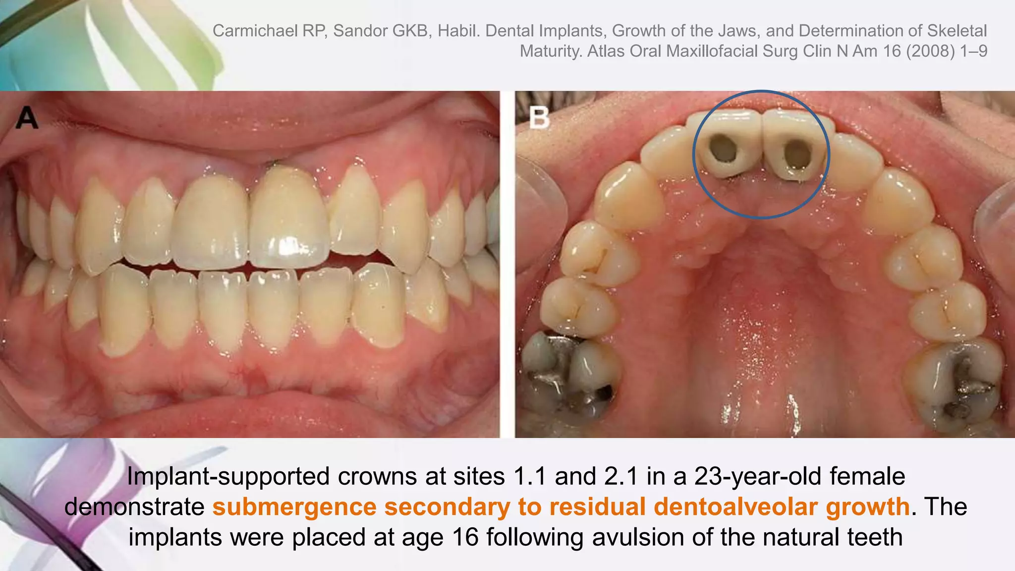 Implant-supported crowns at sites 1.1 and 2.1 in a 23-year-old female
demonstrate submergence secondary to residual dentoalveolar growth. The
implants were placed at age 16 following avulsion of the natural teeth
Carmichael RP, Sandor GKB, Habil. Dental Implants, Growth of the Jaws, and Determination of Skeletal
Maturity. Atlas Oral Maxillofacial Surg Clin N Am 16 (2008) 1–9
 