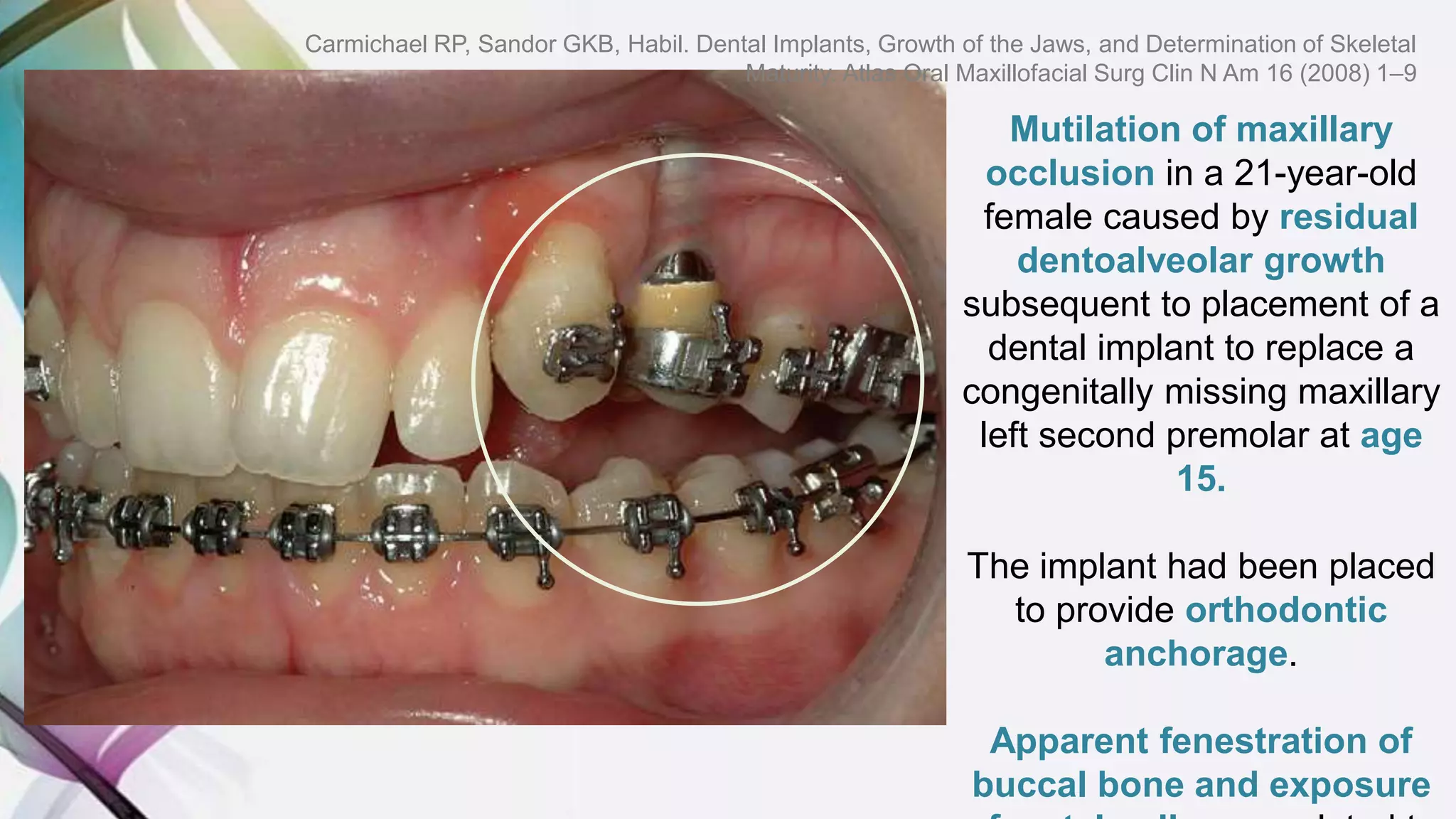 Mutilation of maxillary
occlusion in a 21-year-old
female caused by residual
dentoalveolar growth
subsequent to placement of a
dental implant to replace a
congenitally missing maxillary
left second premolar at age
15.
The implant had been placed
to provide orthodontic
anchorage.
Apparent fenestration of
buccal bone and exposure
Carmichael RP, Sandor GKB, Habil. Dental Implants, Growth of the Jaws, and Determination of Skeletal
Maturity. Atlas Oral Maxillofacial Surg Clin N Am 16 (2008) 1–9
 