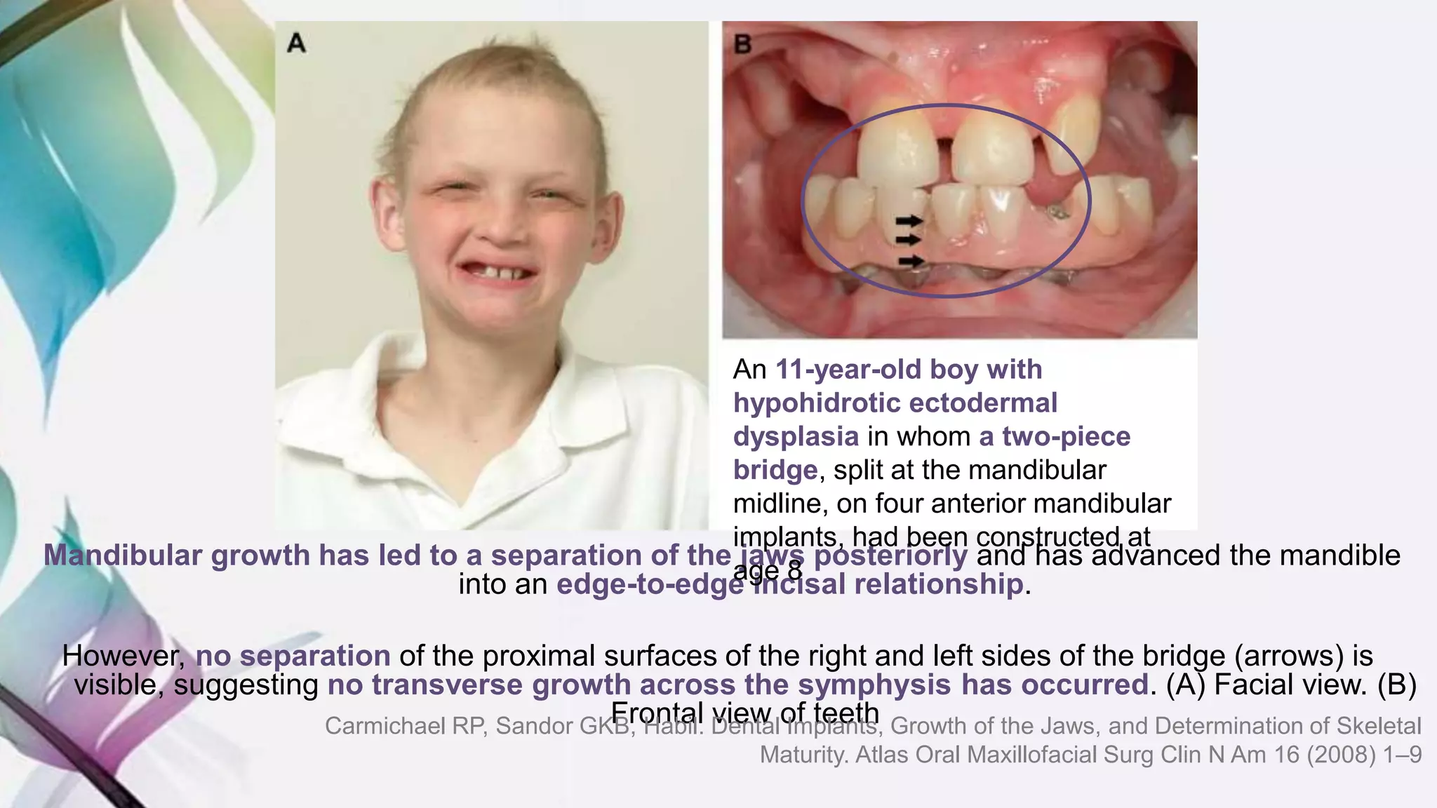 Mandibular growth has led to a separation of the jaws posteriorly and has advanced the mandible
into an edge-to-edge incisal relationship.
However, no separation of the proximal surfaces of the right and left sides of the bridge (arrows) is
visible, suggesting no transverse growth across the symphysis has occurred. (A) Facial view. (B)
Frontal view of teeth
An 11-year-old boy with
hypohidrotic ectodermal
dysplasia in whom a two-piece
bridge, split at the mandibular
midline, on four anterior mandibular
implants, had been constructed at
age 8
Carmichael RP, Sandor GKB, Habil. Dental Implants, Growth of the Jaws, and Determination of Skeletal
Maturity. Atlas Oral Maxillofacial Surg Clin N Am 16 (2008) 1–9
 