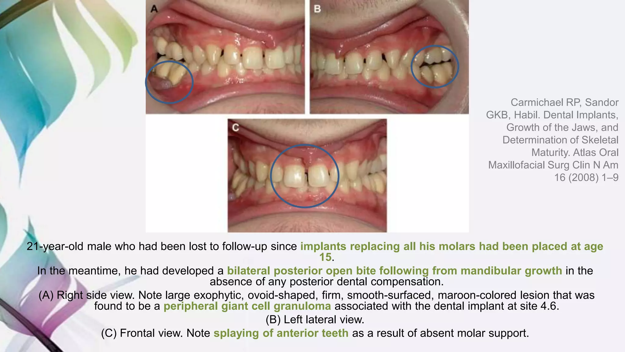 21-year-old male who had been lost to follow-up since implants replacing all his molars had been placed at age
15.
In the meantime, he had developed a bilateral posterior open bite following from mandibular growth in the
absence of any posterior dental compensation.
(A) Right side view. Note large exophytic, ovoid-shaped, firm, smooth-surfaced, maroon-colored lesion that was
found to be a peripheral giant cell granuloma associated with the dental implant at site 4.6.
(B) Left lateral view.
(C) Frontal view. Note splaying of anterior teeth as a result of absent molar support.
Carmichael RP, Sandor
GKB, Habil. Dental Implants,
Growth of the Jaws, and
Determination of Skeletal
Maturity. Atlas Oral
Maxillofacial Surg Clin N Am
16 (2008) 1–9
 