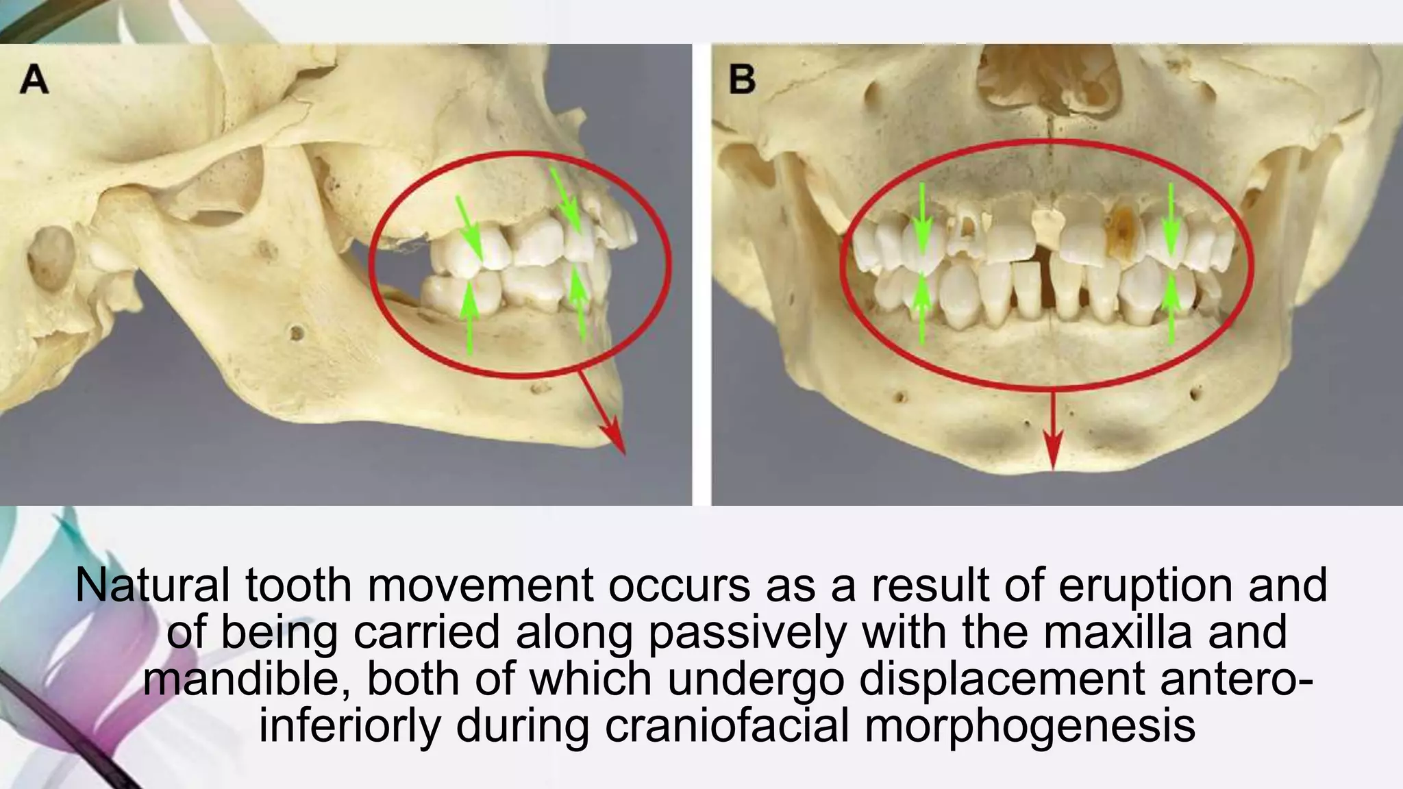 Natural tooth movement occurs as a result of eruption and
of being carried along passively with the maxilla and
mandible, both of which undergo displacement antero-
inferiorly during craniofacial morphogenesis
 