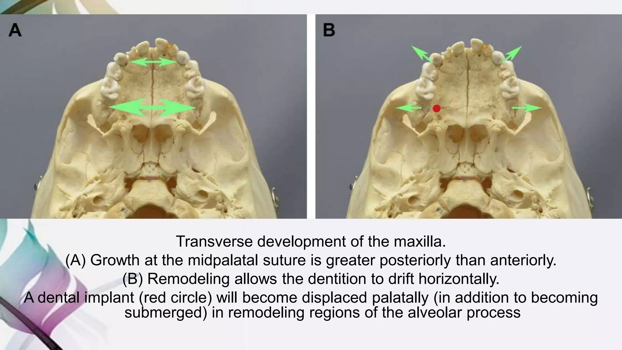 Transverse development of the maxilla.
(A) Growth at the midpalatal suture is greater posteriorly than anteriorly.
(B) Remodeling allows the dentition to drift horizontally.
A dental implant (red circle) will become displaced palatally (in addition to becoming
submerged) in remodeling regions of the alveolar process
 