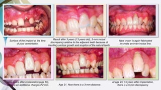Surface of the implant at the time
of post cementation
Result after 3 years (13 years old), 3-mm incisal
discrepancy relative to the adjacent teeth because of
maxillary vertical growth and eruption of the natural teeth.
New crown is again fabricated
to create an even incisal line.
Nine years after implantation (age 19),
there is an additional change of 2 mm. Age 21. Now there is a 3-mm distance.
At age 25, 15 years after implantation,
there is a 5-mm discrepancy
 