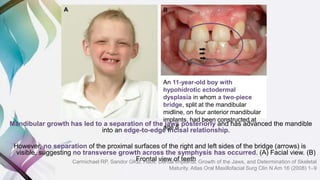 Mandibular growth has led to a separation of the jaws posteriorly and has advanced the mandible
into an edge-to-edge incisal relationship.
However, no separation of the proximal surfaces of the right and left sides of the bridge (arrows) is
visible, suggesting no transverse growth across the symphysis has occurred. (A) Facial view. (B)
Frontal view of teeth
An 11-year-old boy with
hypohidrotic ectodermal
dysplasia in whom a two-piece
bridge, split at the mandibular
midline, on four anterior mandibular
implants, had been constructed at
age 8
Carmichael RP, Sandor GKB, Habil. Dental Implants, Growth of the Jaws, and Determination of Skeletal
Maturity. Atlas Oral Maxillofacial Surg Clin N Am 16 (2008) 1–9
 