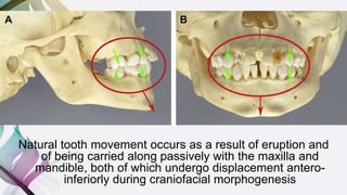 Natural tooth movement occurs as a result of eruption and
of being carried along passively with the maxilla and
mandible, both of which undergo displacement antero-
inferiorly during craniofacial morphogenesis
 