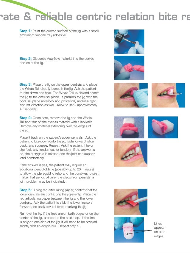 Using the lucia jig for accurate bite s220