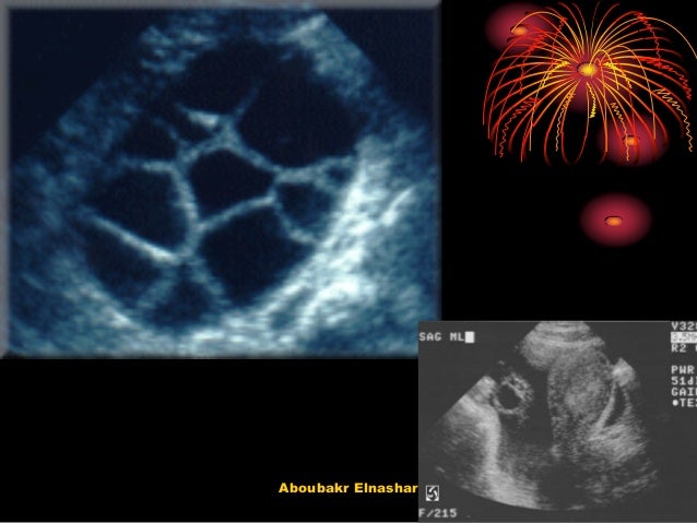 Clomid Complications Bloating Pain Multiple Follicles