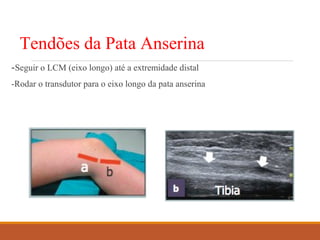 Tendões da Pata Anserina
-Seguir o LCM (eixo longo) até a extremidade distal
-Rodar o transdutor para o eixo longo da pata anserina
 