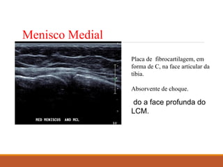 Menisco Medial
Placa de fibrocartilagem, em
forma de C, na face articular da
tíbia.
Absorvente de choque.
do a face profunda do
LCM.
 