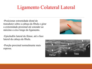 Ligamento Colateral Lateral
-Posicionar extremidade distal do
transdutor sobre a cabeça da fíbula e girar
a extremidade proximal até estender ao
máximo o eixo longo do ligamento.
-Epicôndilo lateral do fêmur, até a face
lateral da cabeça da fíbula.
-Porção proximal normalmente mais
espessa.
 