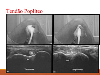 Tendão Poplíteo
 