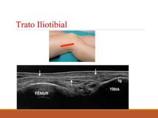 Trato Iliotibial
 