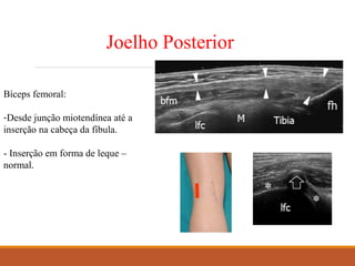 Joelho Posterior
Bíceps femoral:
-Desde junção miotendínea até a
inserção na cabeça da fíbula.
- Inserção em forma de leque –
normal.
 