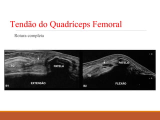 Tendão do Quadríceps Femoral
Rotura completa
 