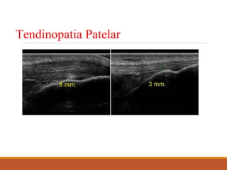 Tendinopatia Patelar
 