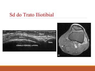 Sd do Trato Iliotibial
 