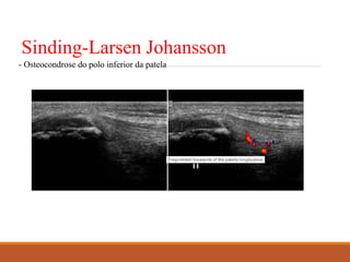 Sinding-Larsen Johansson
- Osteocondrose do polo inferior da patela
 