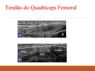 Tendão do Quadriceps Femoral
 