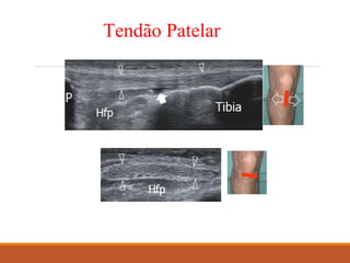 Tendão Patelar
 