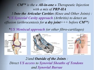 Use of PRP-HA for the Treatment of Articular and Peri-Articular ...