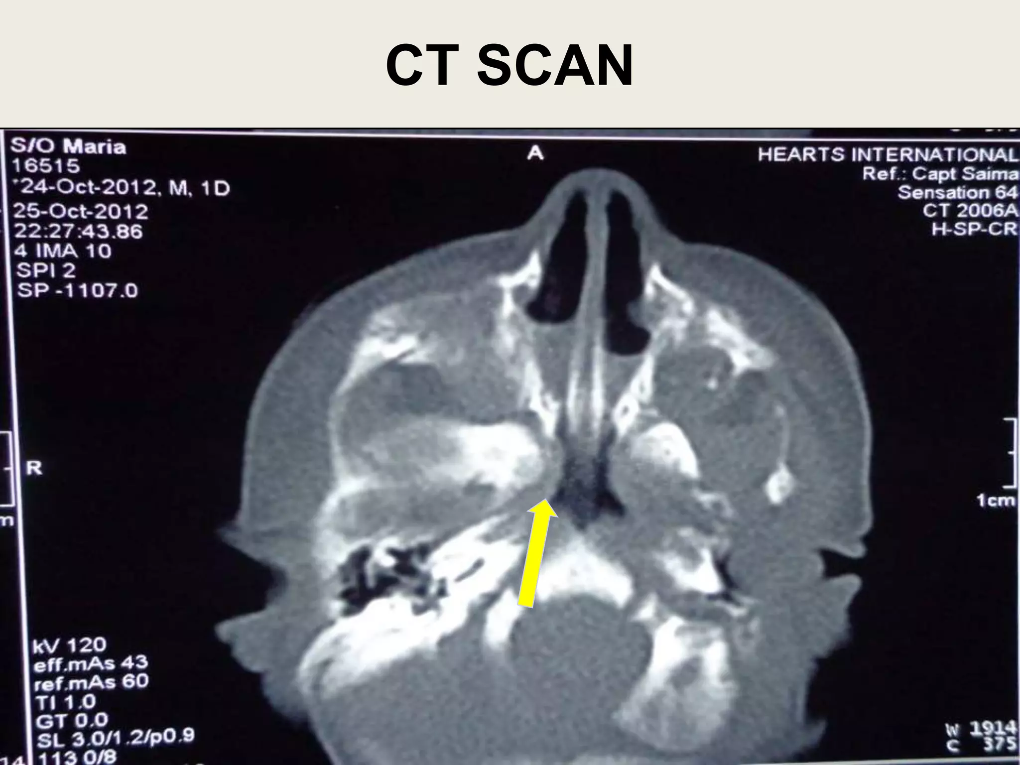 choanal atresia | PPT