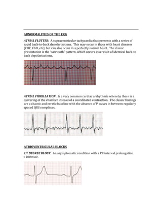  
 
ABNORMALITIES OF THE EKG 
ATRIAL FLUTTER:  A supraventricular tachycardia that presents with a series of 
rapid back‐to‐back depolarizations.  This may occur in those with heart diseases 
(CHF, CAD, etc), but can also occur in a perfectly normal heart.  The classic 
presentation is the “sawtooth” pattern, which occurs as a result of identical back‐to‐
back depolarizations. 
 
 
ATRIAL FIBRILLATION:  Is a very common cardiac arrhythmia whereby there is a 
quivering of the chamber instead of a coordinated contraction.  The classic findings 
are a chaotic and erratic baseline with the absence of P waves in between regularly 
spaced QRS complexes. 
 
 
ATRIOVENTRICULAR BLOCKS 
1ST DEGREE BLOCK:  An asymptomatic condition with a PR interval prolongation 
>200msec. 
 
 