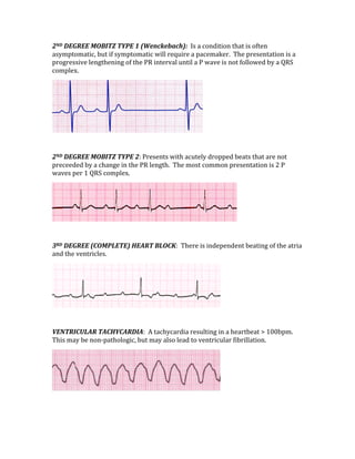 2ND DEGREE MOBITZ TYPE 1 (Wenckebach):  Is a condition that is often 
asymptomatic, but if symptomatic will require a pacemaker.  The presentation is a 
progressive lengthening of the PR interval until a P wave is not followed by a QRS 
complex. 
 
 
2ND DEGREE MOBITZ TYPE 2: Presents with acutely dropped beats that are not 
preceeded by a change in the PR length.  The most common presentation is 2 P 
waves per 1 QRS complex. 
 
 
3RD DEGREE (COMPLETE) HEART BLOCK:  There is independent beating of the atria 
and the ventricles. 
 
 
VENTRICULAR TACHYCARDIA:  A tachycardia resulting in a heartbeat > 100bpm.  
This may be non‐pathologic, but may also lead to ventricular fibrillation. 
 
 
 
