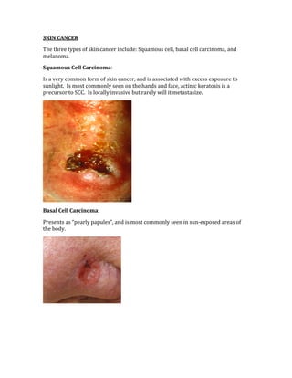SKIN CANCER 
The three types of skin cancer include: Squamous cell, basal cell carcinoma, and 
melanoma. 
Squamous Cell Carcinoma: 
Is a very common form of skin cancer, and is associated with excess exposure to 
sunlight.  Is most commonly seen on the hands and face, actinic keratosis is a 
precursor to SCC.  Is locally invasive but rarely will it metastasize. 
 
Basal Cell Carcinoma: 
Presents as “pearly papules”, and is most commonly seen in sun‐exposed areas of 
the body. 
 
 
 
 
 