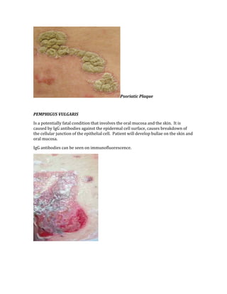 Psoriatic Plaque 
 
PEMPHIGUS VULGARIS 
Is a potentially fatal condition that involves the oral mucosa and the skin.  It is 
caused by IgG antibodies against the epidermal cell surface, causes breakdown of 
the cellular junction of the epithelial cell.  Patient will develop bullae on the skin and 
oral mucosa. 
IgG antibodies can be seen on immunofluorescence. 
 
 
 
 