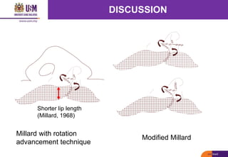 Unilateral Cleft Lip and Palate Treatment Outcome Assessment | PPTX