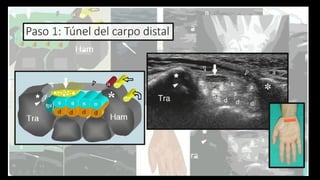 Ultrasound Imaging of the Wrist: Tendons, Nerves, Bone Cortex, and ...