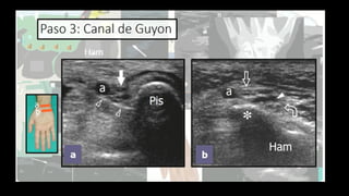 Ultrasound Imaging of the Wrist: Tendons, Nerves, Bone Cortex, and ...