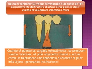 Cuando el puente es cargado oclusalmente, se producen
fuerzas laterales, el pilar adyacente tiende a actuar
como un fulcrumcon una tendencia a levantar el pilar
más lejano, generando inclinaciones
Su uso es controversial ya que corresponde a un diseño de PFP
potencialmente destructivo al actuar como palanca clase I
cuando el voladizo es sometido a carga
 