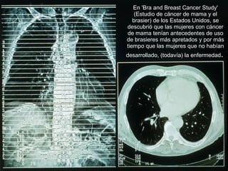 En 'Bra and Breast Cancer Study' (Estudio de cáncer de mama y el brasier) de los Estados Unidos, se descubrió que las mujeres con cáncer de mama tenían antecedentes de uso de brasieres más apretados y por más tiempo que las mujeres que no habían desarrollado, (todavía) la enfermedad .   