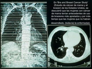En 'Bra and Breast Cancer Study'
    (Estudio de cáncer de mama y el
   brasier) de los Estados Unidos, se
descubrió que las mujeres con cáncer
de mama tenían antecedentes de uso
de brasieres más apretados y por más
tiempo que las mujeres que no habían
desarrollado, (todavía) la enfermedad.
 