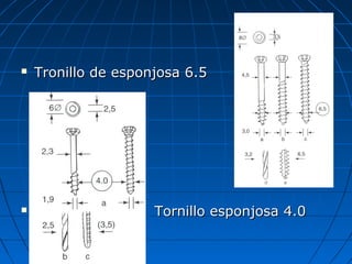  TTrroonniilllloo ddee eessppoonnjjoossaa 66..55 
 TToorrnniilllloo eessppoonnjjoossaa 44..00 
 