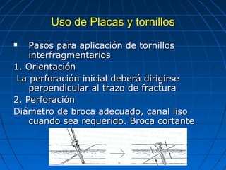 UUssoo ddee PPllaaccaass yy ttoorrnniillllooss 
 PPaassooss ppaarraa aapplliiccaacciióónn ddee ttoorrnniillllooss 
iinntteerrffrraaggmmeennttaarriiooss 
11.. OOrriieennttaacciióónn 
LLaa ppeerrffoorraacciióónn iinniicciiaall ddeebbeerráá ddiirriiggiirrssee 
ppeerrppeennddiiccuullaarr aall ttrraazzoo ddee ffrraaccttuurraa 
22.. PPeerrffoorraacciióónn 
DDiiáámmeettrroo ddee bbrrooccaa aaddeeccuuaaddoo,, ccaannaall lliissoo 
ccuuaannddoo sseeaa rreeqquueerriiddoo.. BBrrooccaa ccoorrttaannttee 
 
