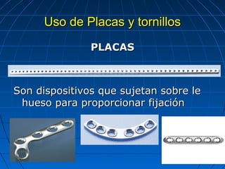 UUssoo ddee PPllaaccaass yy ttoorrnniillllooss 
PPLLAACCAASS 
SSoonn ddiissppoossiittiivvooss qquuee ssuujjeettaann ssoobbrree llee 
hhuueessoo ppaarraa pprrooppoorrcciioonnaarr ffiijjaacciióónn 
 