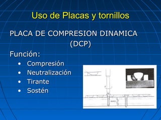 UUssoo ddee PPllaaccaass yy ttoorrnniillllooss 
PPLLAACCAA DDEE CCOOMMPPRREESSIIOONN DDIINNAAMMIICCAA 
((DDCCPP)) 
FFuunncciióónn:: 
• CCoommpprreessiióónn 
• NNeeuuttrraalliizzaacciióónn 
• TTiirraannttee 
• SSoossttéénn 
 
