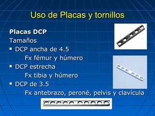 UUssoo ddee PPllaaccaass yy ttoorrnniillllooss 
PPllaaccaass DDCCPP 
TTaammaaññooss 
 DDCCPP aanncchhaa ddee 44..55 
FFxx fféémmuurr yy hhúúmmeerroo 
 DDCCPP eessttrreecchhaa 
FFxx ttiibbiiaa yy hhúúmmeerroo 
 DDCCPP ddee 33..55 
FFxx aanntteebbrraazzoo,, ppeerroonnéé,, ppeellvviiss yy ccllaavvííccuullaa 
 